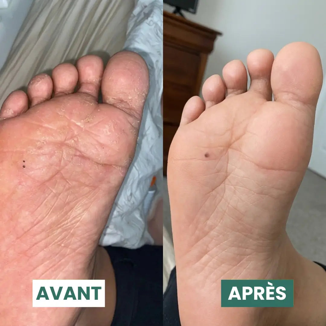 Savon Purifiant Antifongique
