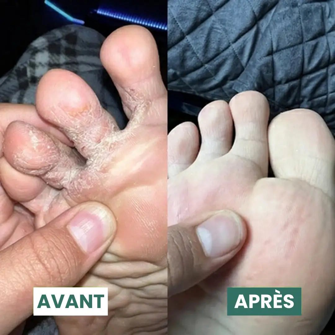 Savon Purifiant Antifongique